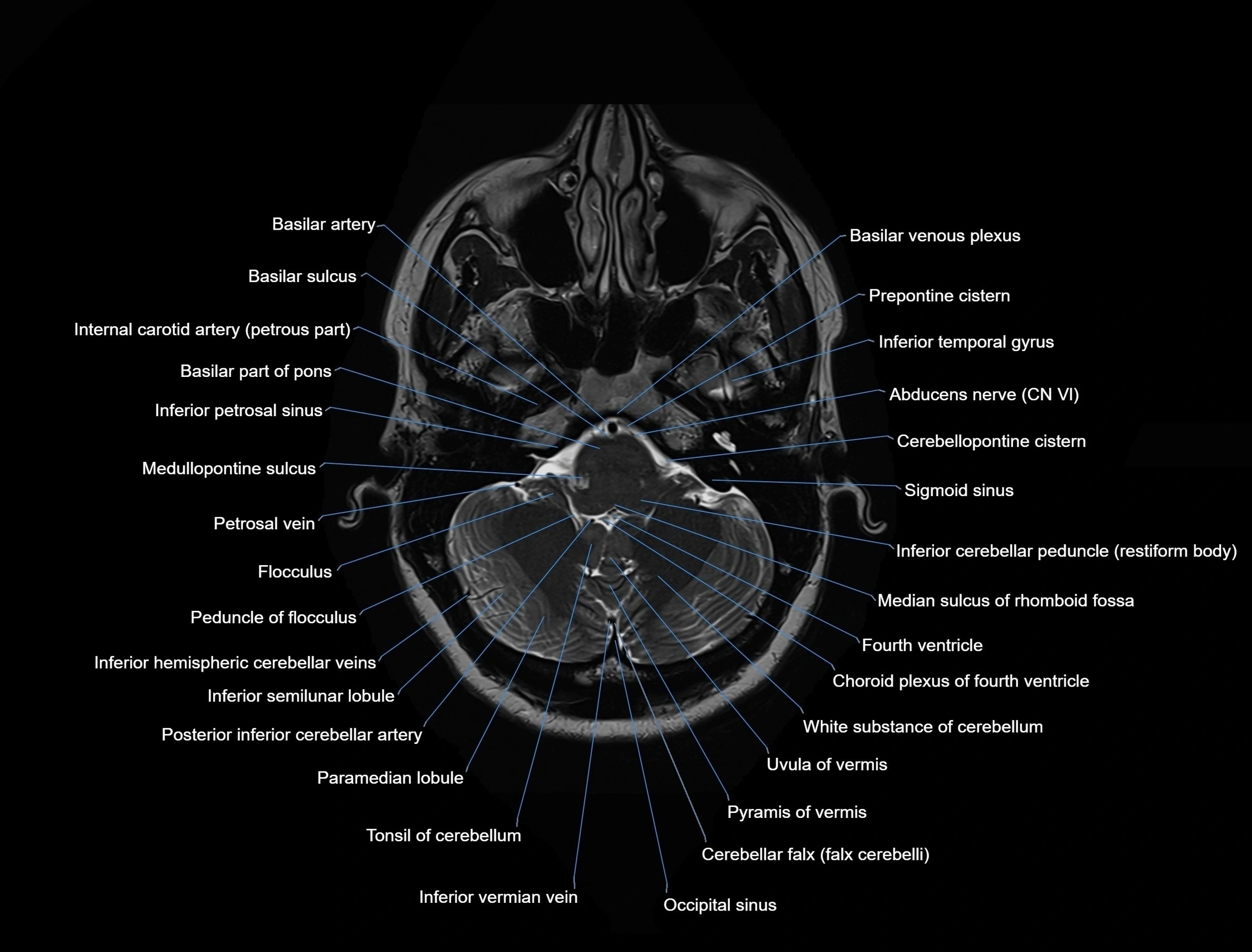 MRI Brain axial cross sectional radiology anatomy 3T image  -img-00001-00011.webp